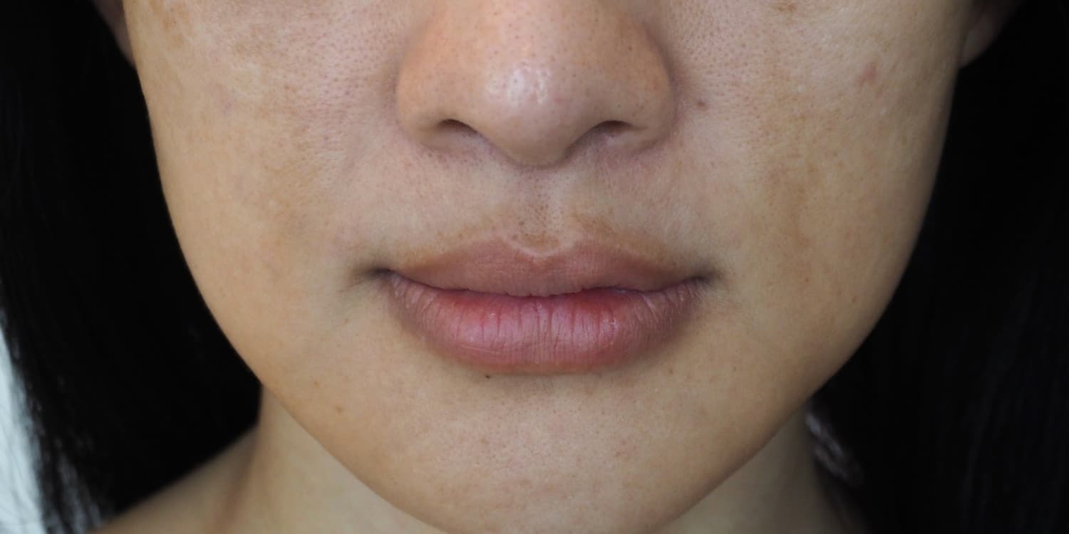 Closeup of a woman with dark spots.